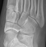 Navicular Stress Fracture